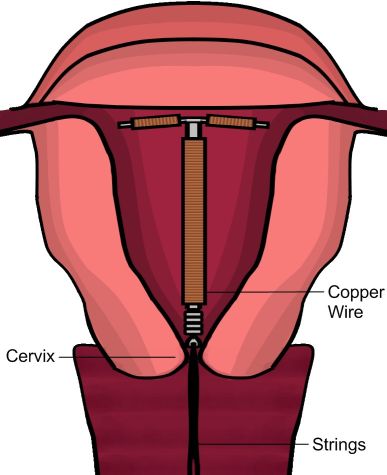 Iud diagram