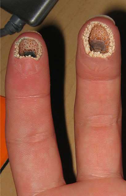 hole in fingers